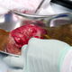Image for article titled That's the Way the Pilar Cyst Bounces on Dr. Pimple Popper